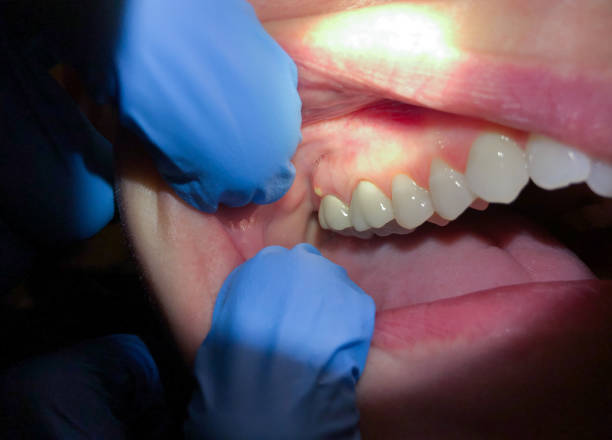 Best Emergency Denture Repair in South Farmingdale, NY
